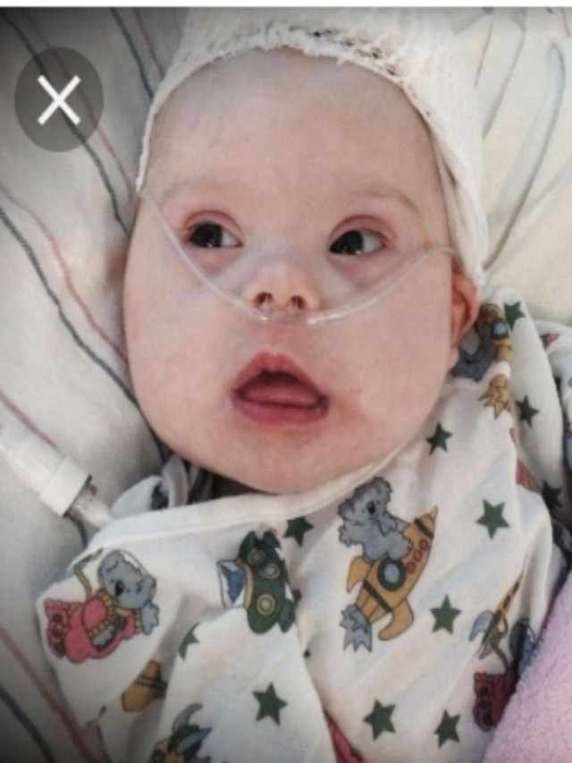 Lista 96+ Foto 1 mes bebes con sindrome de down recien nacidos Cena hermosa
