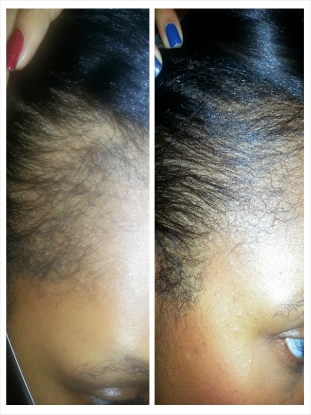 Lista 103+ Imagen 7 day 1 month castor oil hair results El último