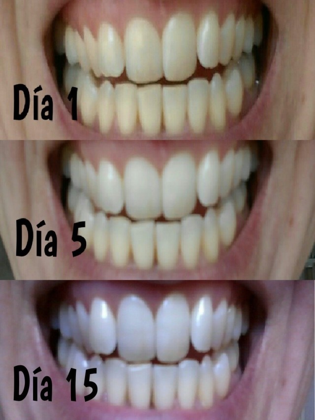 Sintético 105+ Foto aceite de coco y curcuma para blanquear los dientes Actualizar