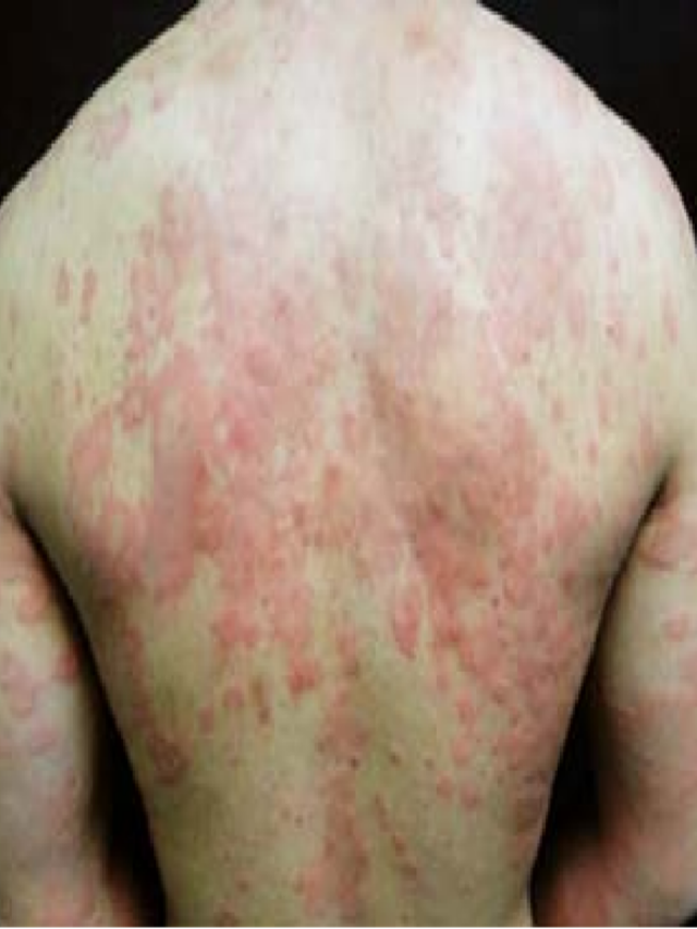 Lista 95+ Foto alergias en la piel en niños urticaria Cena hermosa