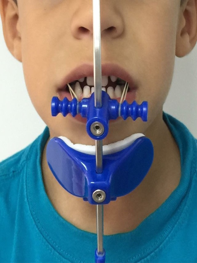 Sintético 98+ Foto aparatos para los dientes de niños Cena hermosa