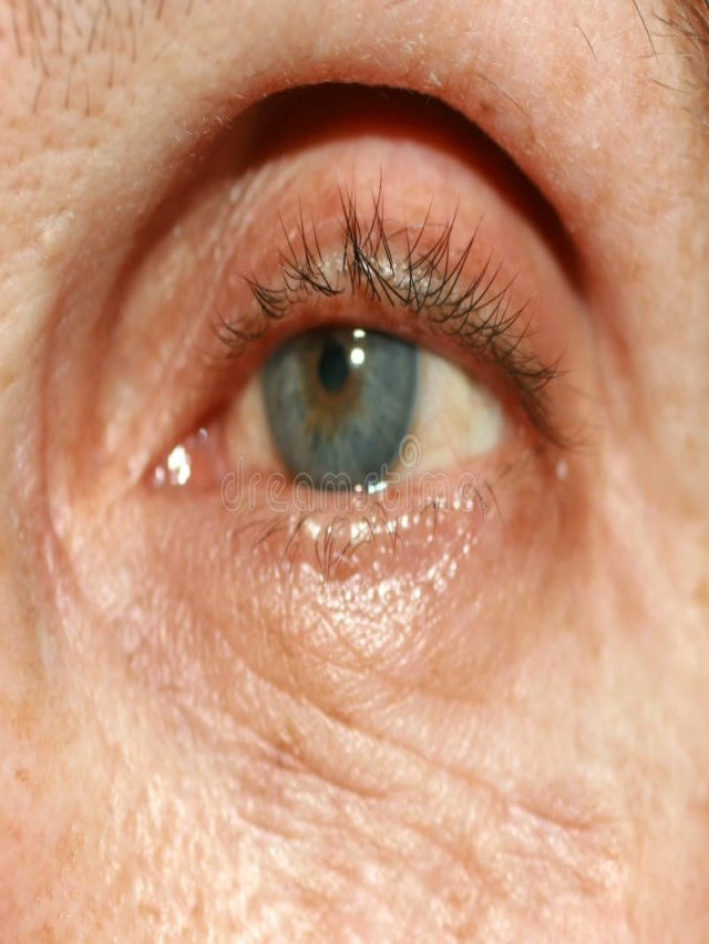 Sintético 91+ Foto arrugas bajo los ojos joven causas Mirada tensa