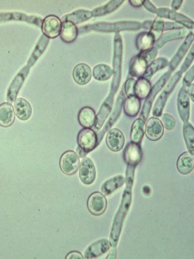 Sintético 104+ Foto candidiasis hongos en los genitales femeninos fotos Actualizar