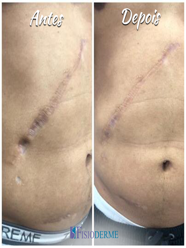 Arriba 103+ Foto cicatriz cirugia de vesicula con laser El último