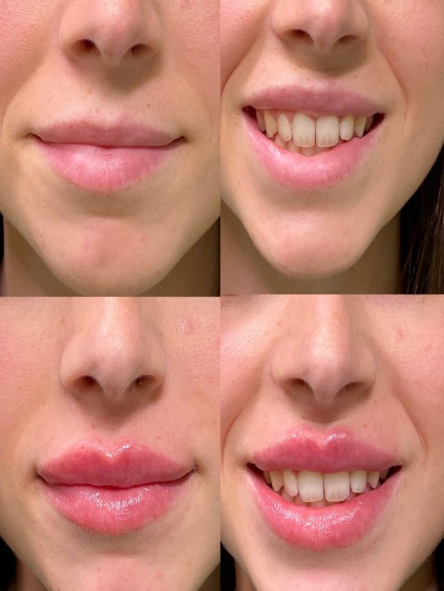 Lista 104+ Foto cirugía de labios antes y después Actualizar