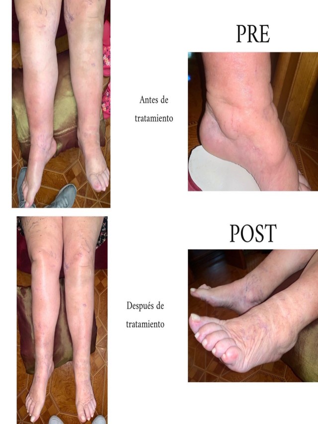 Sintético 102+ Foto cirugía de piernas antes y después Cena hermosa