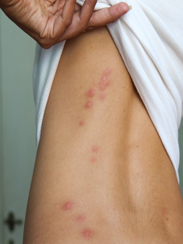 Lista 98+ Foto close up pictures of bed bug bites Actualizar