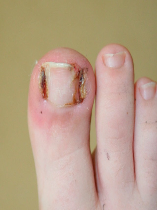 Lista 99+ Foto como desinflamar el dedo gordo del pie por uña enterrada Actualizar