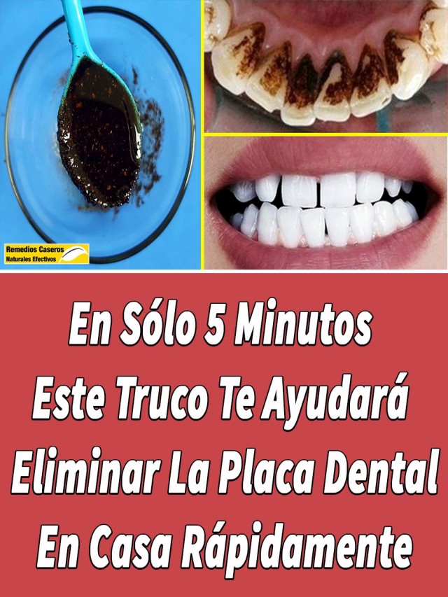 Lista 105+ Foto como detener una hemorragia dental en casa Lleno