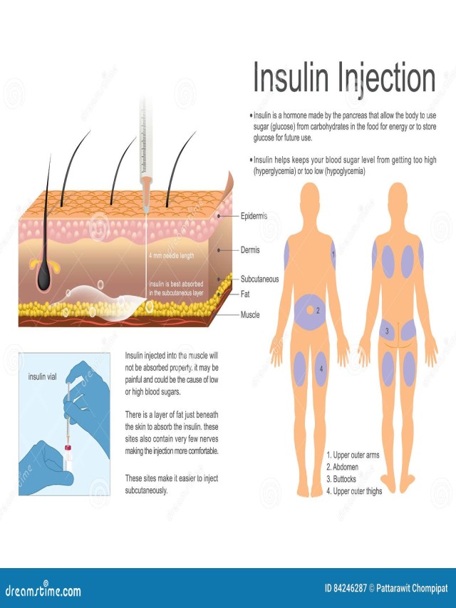 Lista 103+ Foto como inyectar insulina en la pierna Actualizar