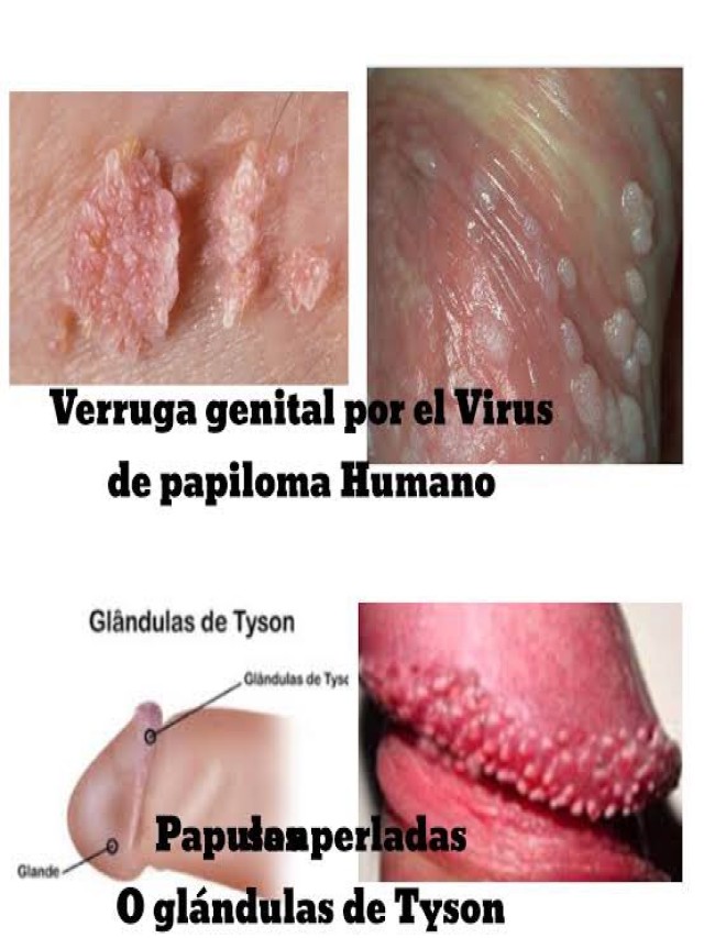 Álbumes 105+ Foto como se ve el herpes genital fotos Mirada tensa