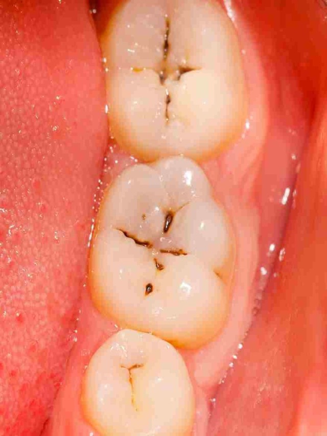 Sintético 97+ Foto como son las caries en los dientes fotos Mirada tensa