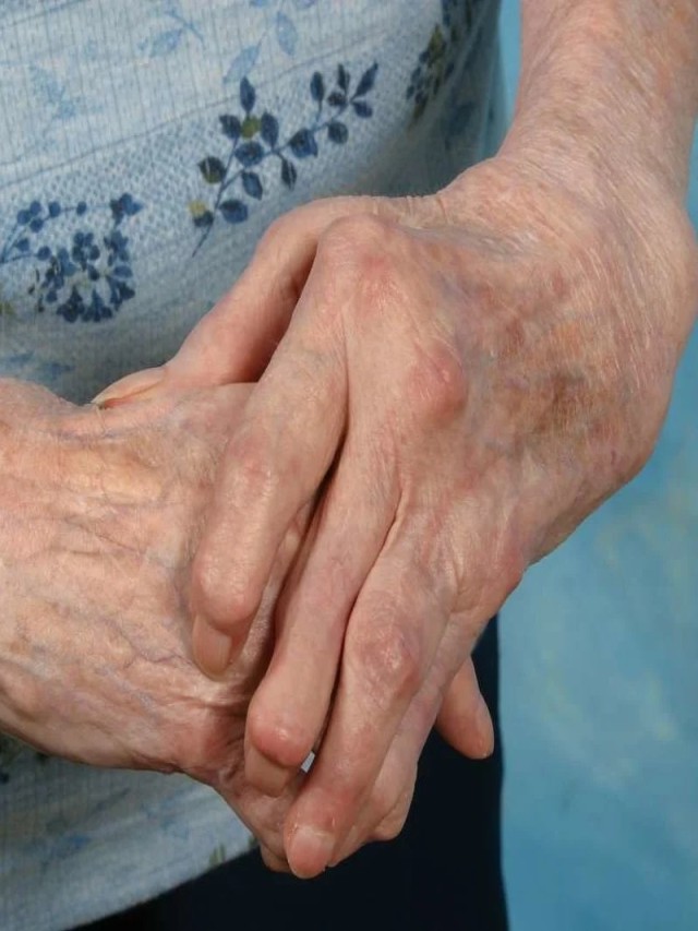 Lista 94+ Foto dedos artritis en las manos jovenes Alta definición completa, 2k, 4k