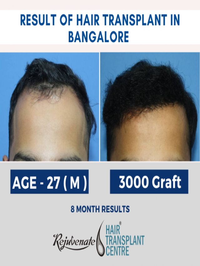 Arriba 95+ Imagen dermasculpt clinic – best hair transplant in bangalore photos Cena hermosa