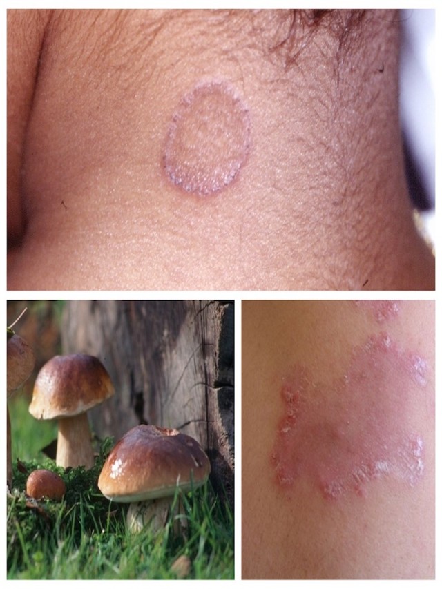 Arriba 105+ Foto enfermedad por hongos en la piel Mirada tensa
