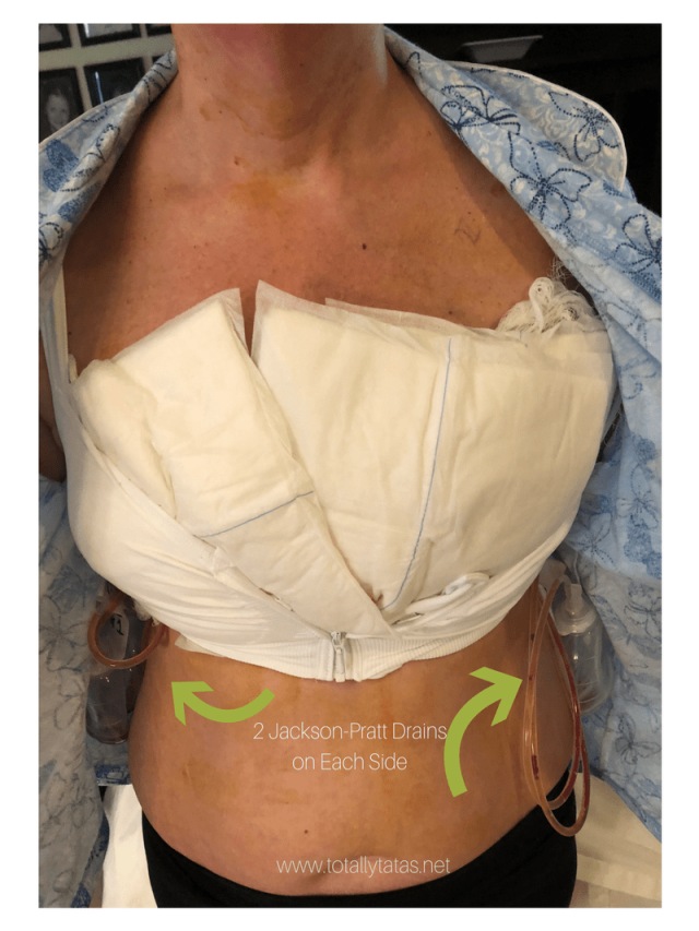 Arriba 91+ Foto fotos de cicatrices de senos operados Lleno
