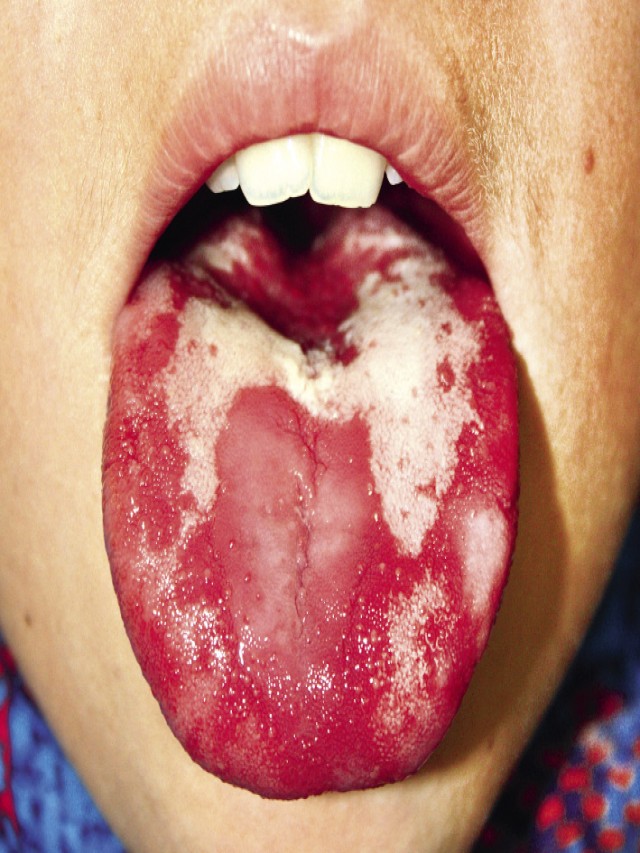 Arriba 101+ Foto fotos de herpes en la lengua Alta definición completa, 2k, 4k
