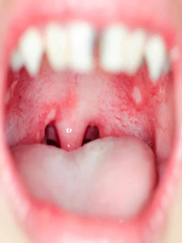 Sintético 101+ Foto fotos de infecciones en la garganta Actualizar