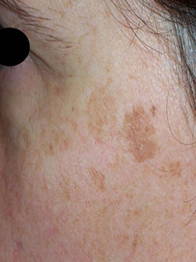 Sintético 94+ Foto fotos de manchas en la piel por el sol Actualizar