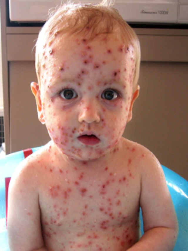 Sintético 96+ Foto fotos de varicela, sarampión y rubéola Actualizar