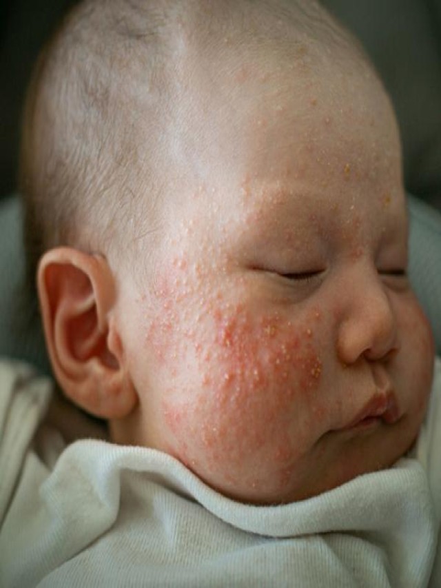 Lista 101+ Foto granitos blancos en la cara de bebe Mirada tensa