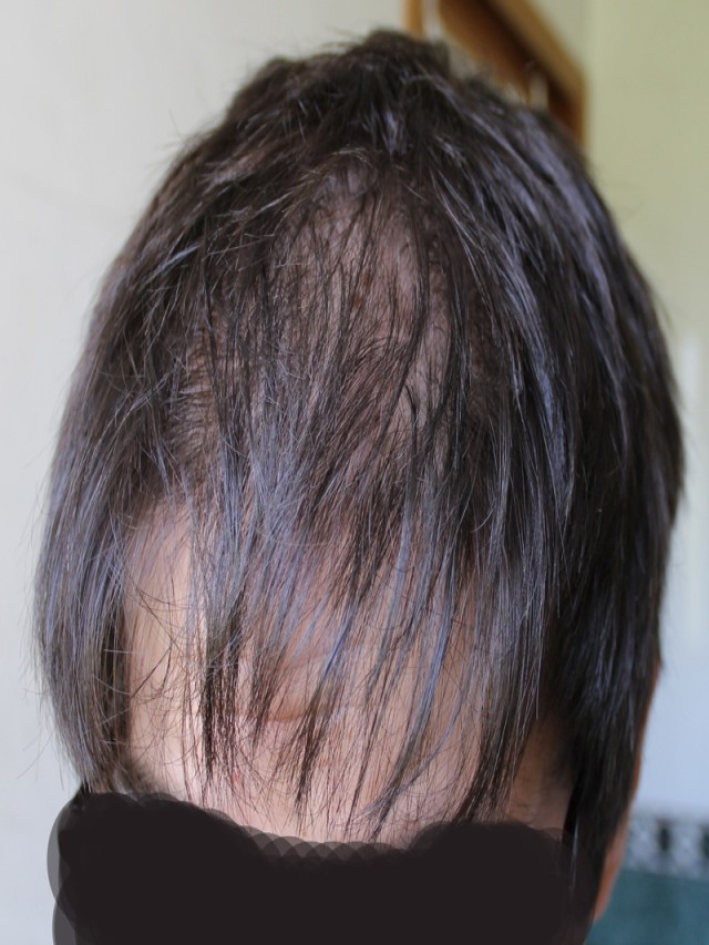 Lista 97+ Imagen how common is hair loss on accutane Mirada tensa