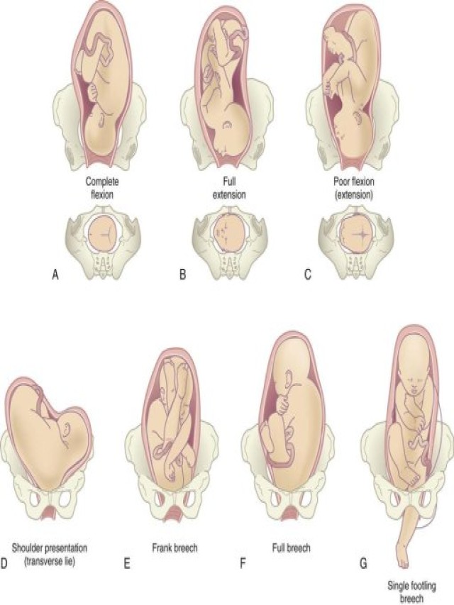 Lista 104+ Foto imagen de feto en posición transversal Actualizar