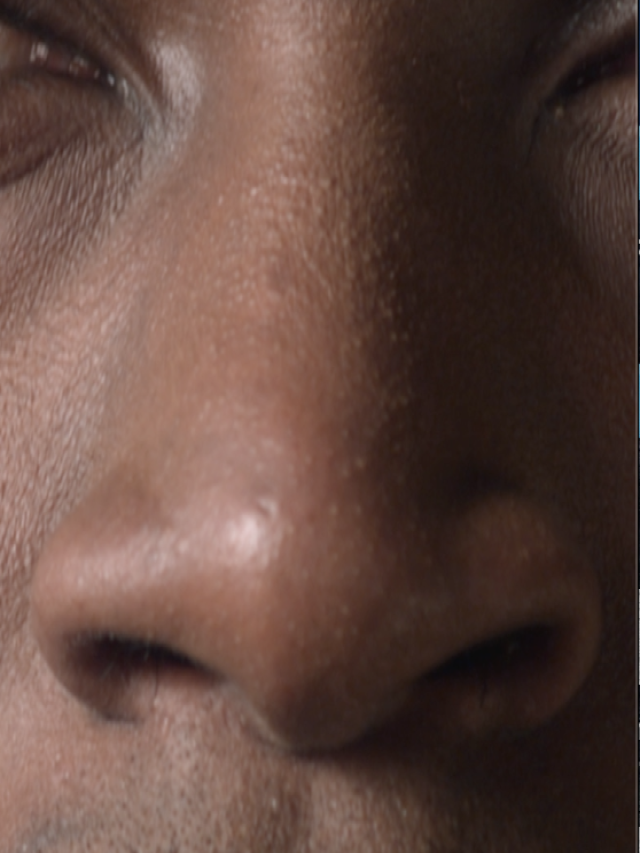 Sintético 95+ Foto imágenes de cáncer en la nariz Lleno