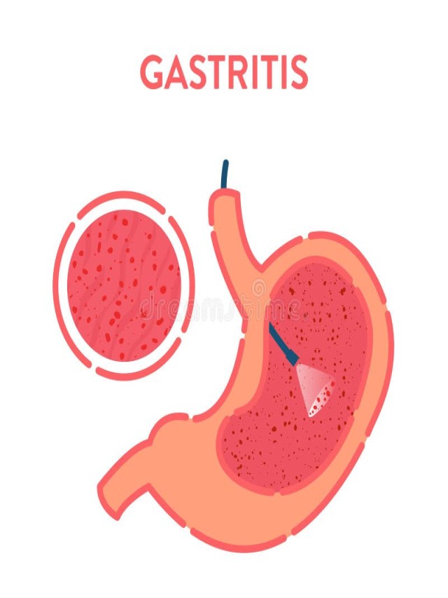 Lista 96+ Foto imagenes de gastritis en el estomago Lleno