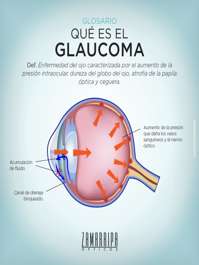 Lista 104+ Foto imagenes de glaucoma en los ojos Mirada tensa