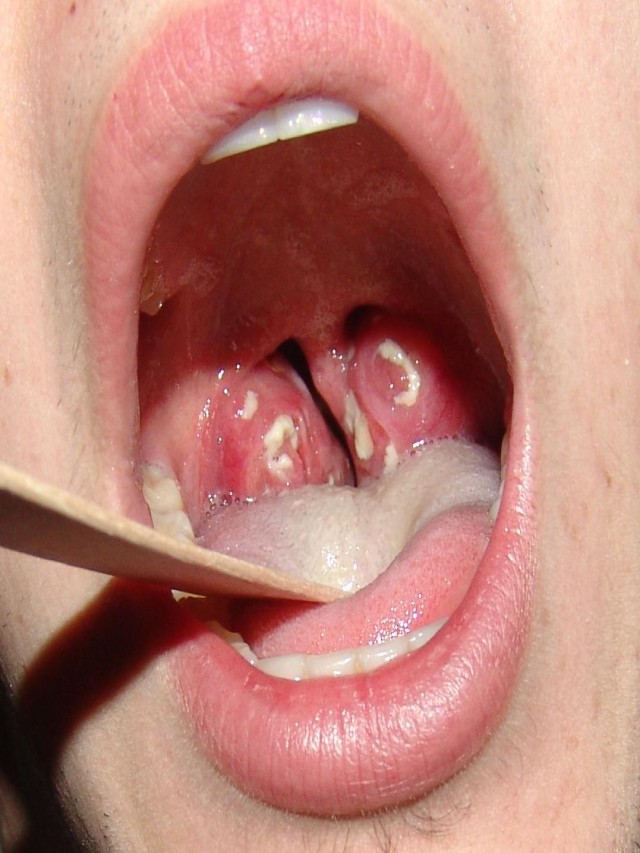 Sintético 91+ Foto imagenes de infecciones en la garganta El último