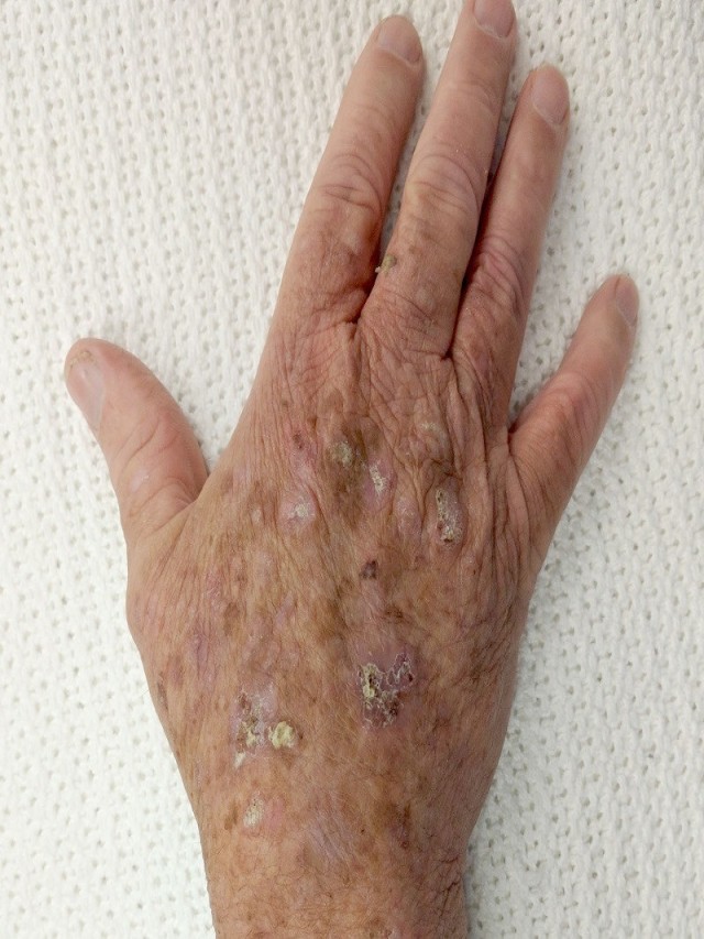 Sintético 99+ Foto imágenes de llagas en la piel Actualizar