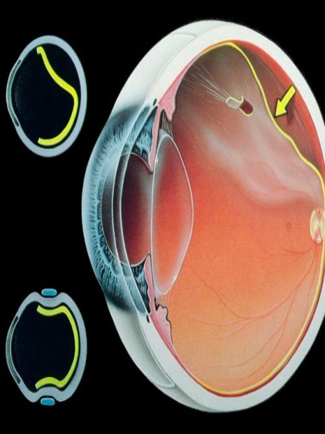 Sintético 92+ Foto imagenes de ojos con desprendimiento de retina El último