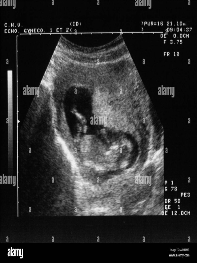 Sintético 92+ Foto imágenes de un feto de 2 meses Cena hermosa