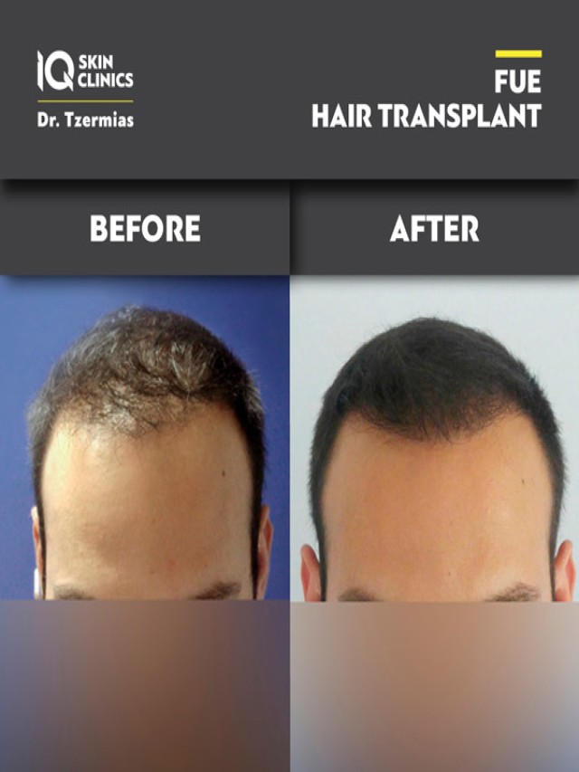 Em geral 94+ Imagen iq hair transplant and skin care reviews Cena hermosa