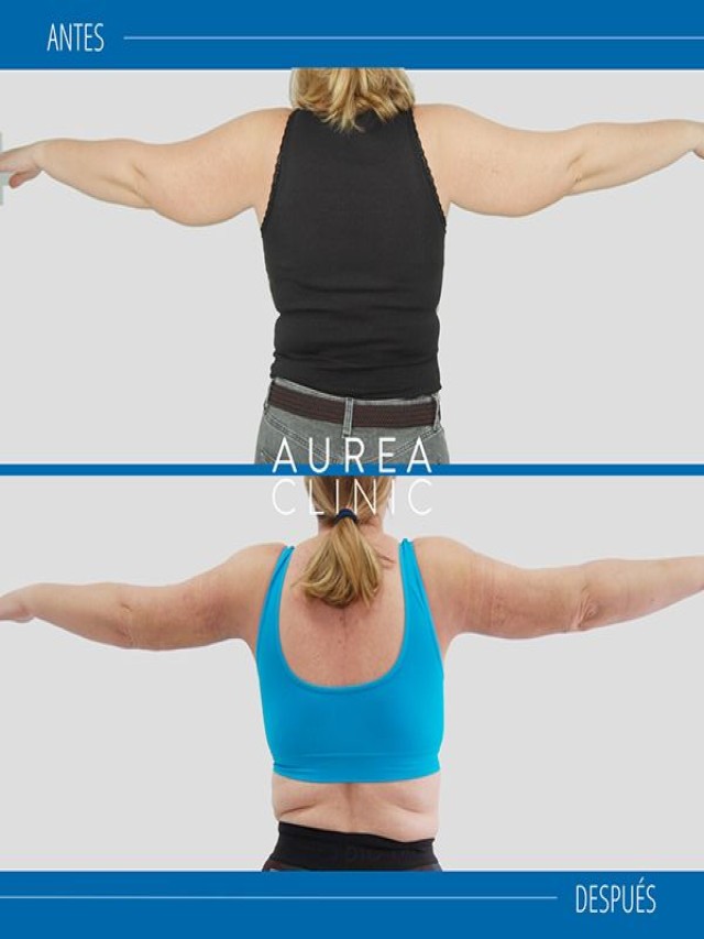 Lista 100+ Foto liposucción de brazos antes y después Actualizar