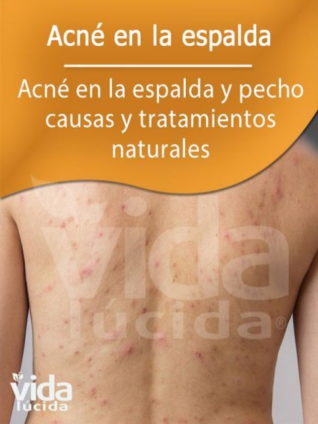 Lista 103+ Foto manchas de acne en la espalda Mirada tensa