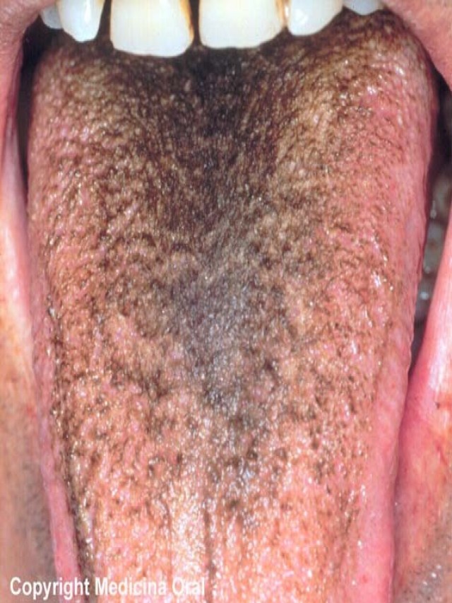 Arriba 100+ Foto manchas negras en la lengua de un adulto Actualizar