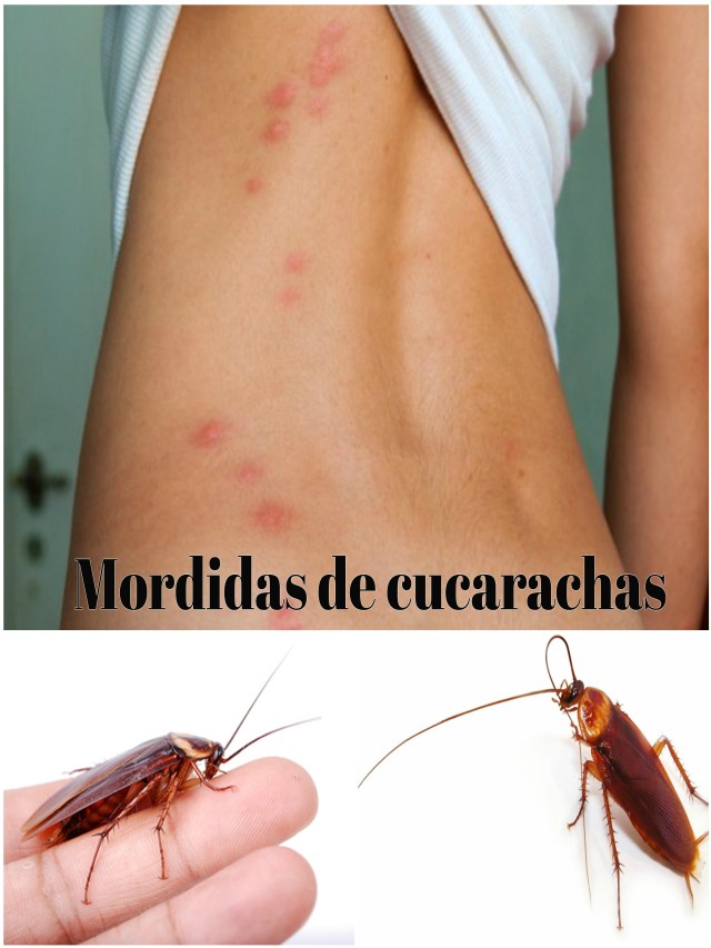 Sintético 103+ Foto mordida de cucaracha en el labio El último