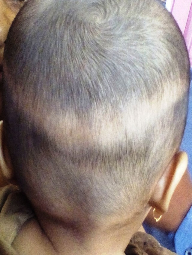 Em geral 104+ Imagen newborn losing hair on top of head Cena hermosa