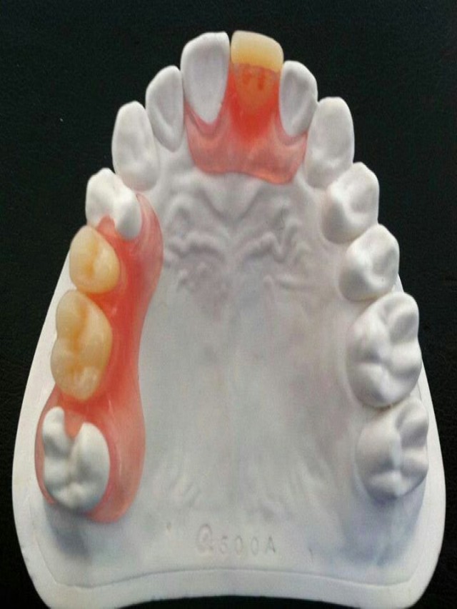 Sintético 95+ Foto protesis flexible de un solo diente Mirada tensa