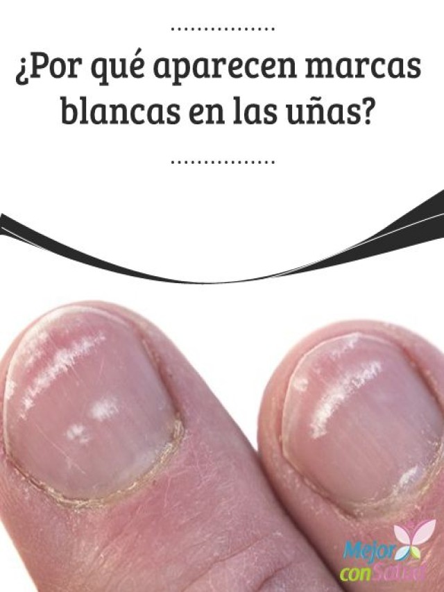 Sintético 91+ Foto que significa las manchas blancas en las uñas Cena hermosa