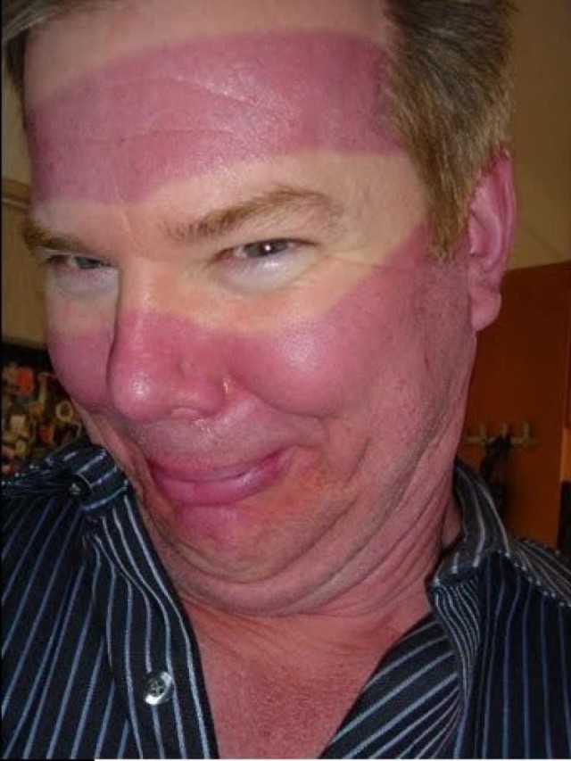 Sintético 90+ Foto quemaduras por el sol en la cara Lleno