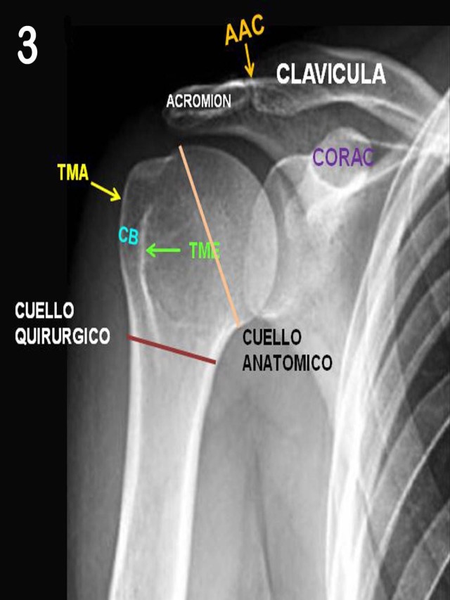 Sintético 99+ Foto radiografia ap y lateral de hombro Alta definición completa, 2k, 4k