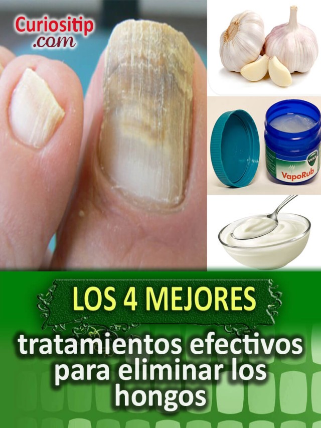 Lista 92+ Foto remedios caseros para el hongo de las uñas Mirada tensa