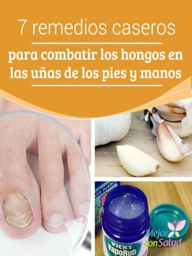 Lista 99+ Foto remedios caseros para hongos en las uñas de las manos Mirada tensa