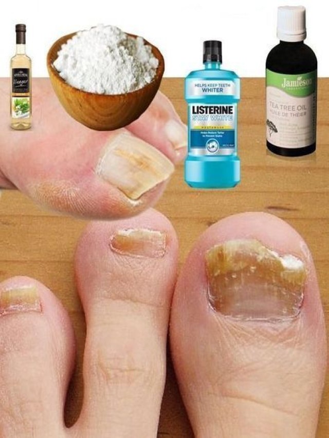 Lista 98+ Foto remedios caseros para hongos en las uñas de los pies Mirada tensa