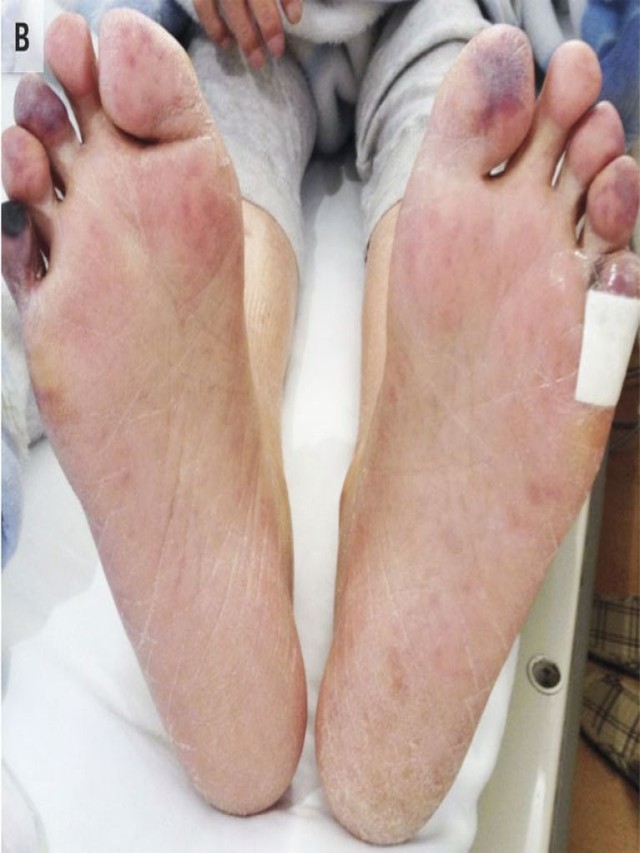 Arriba 91+ Foto sangre molida en el dedo del pie Actualizar