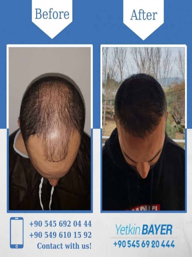 Arriba 100+ Imagen turkey hair transplant cost in indian rupees Lleno