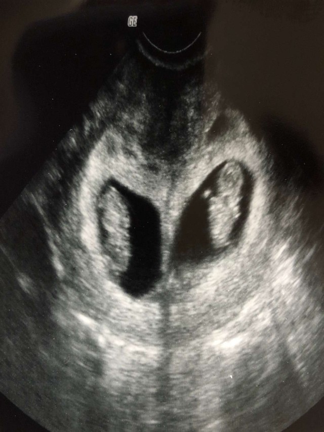 Sintético 100+ Foto ultrasonido de gemelos de 3 meses El último